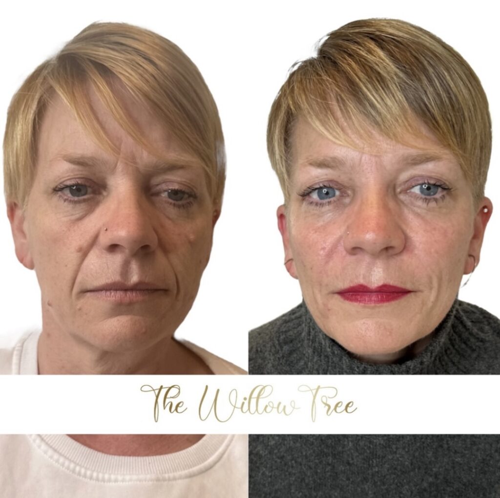 Nasolabial Folds Treatment Norwich