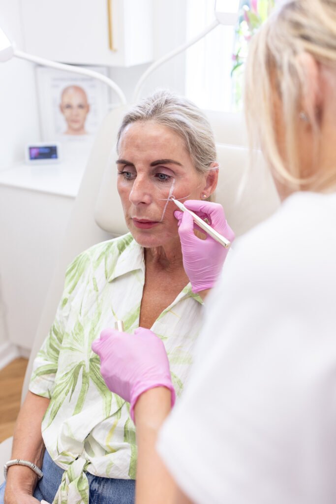 Cheek filler treatment at The Willow Tree Norwich